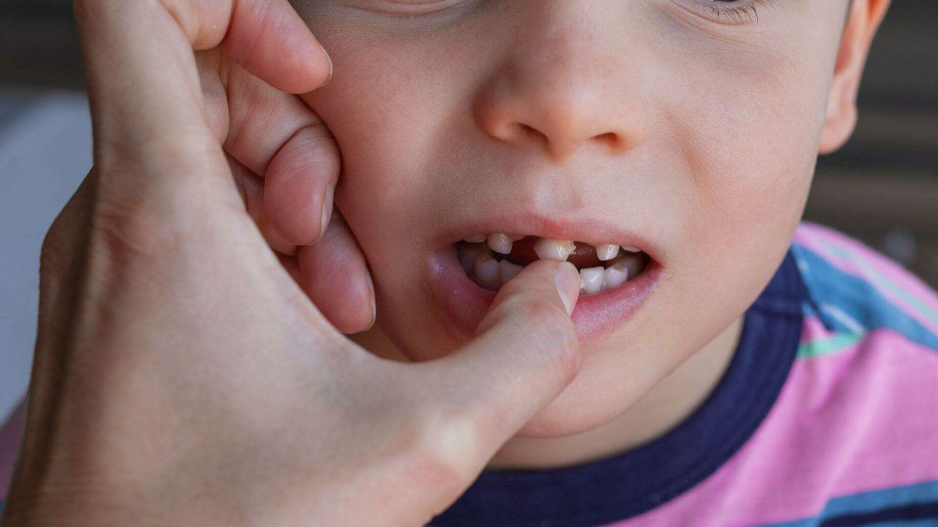 loss teeth